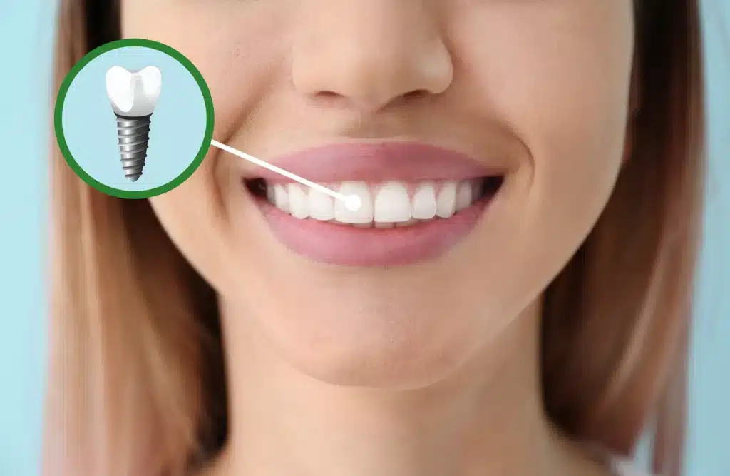 dental implants denton