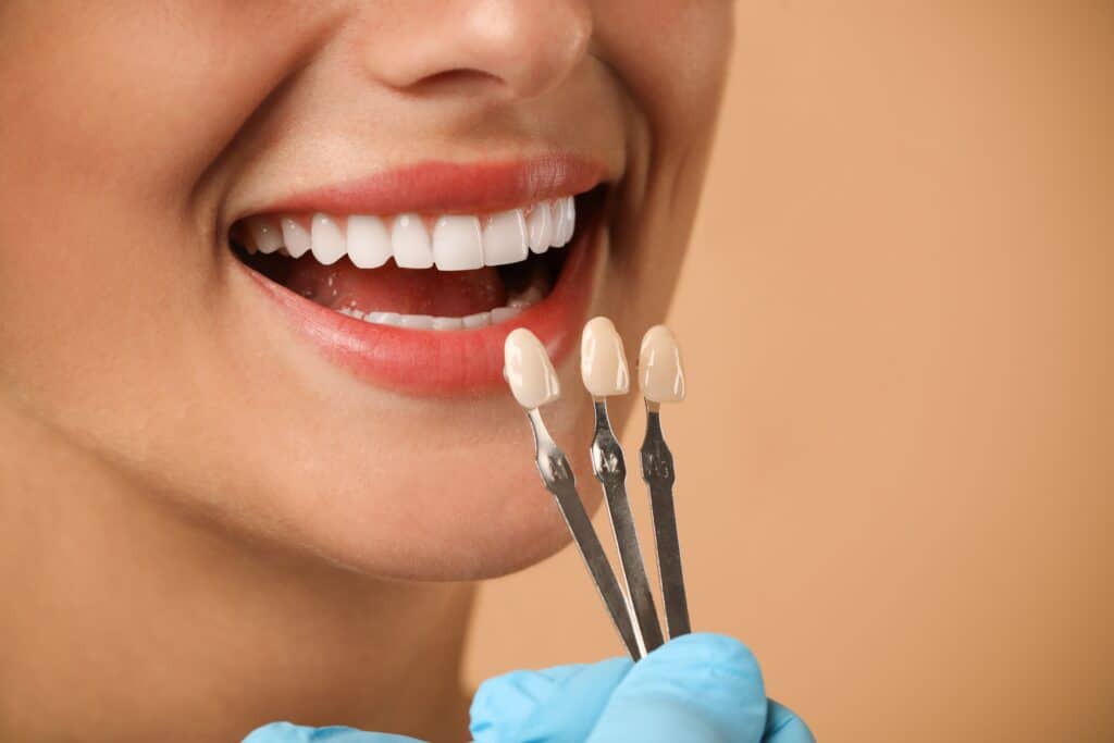 dental veneers denton