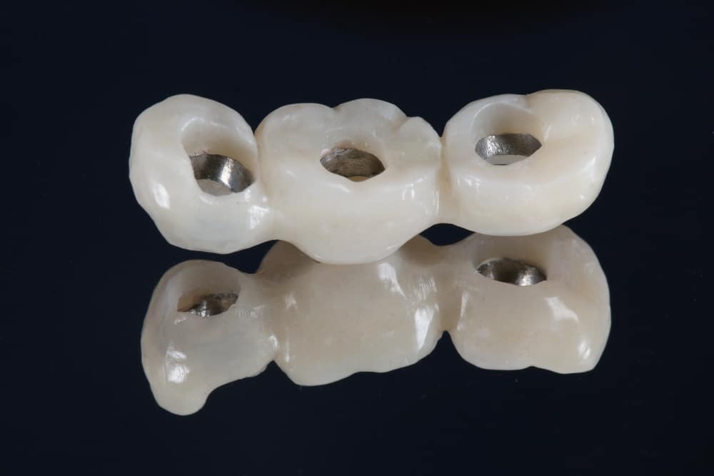 dental bridges vs implants