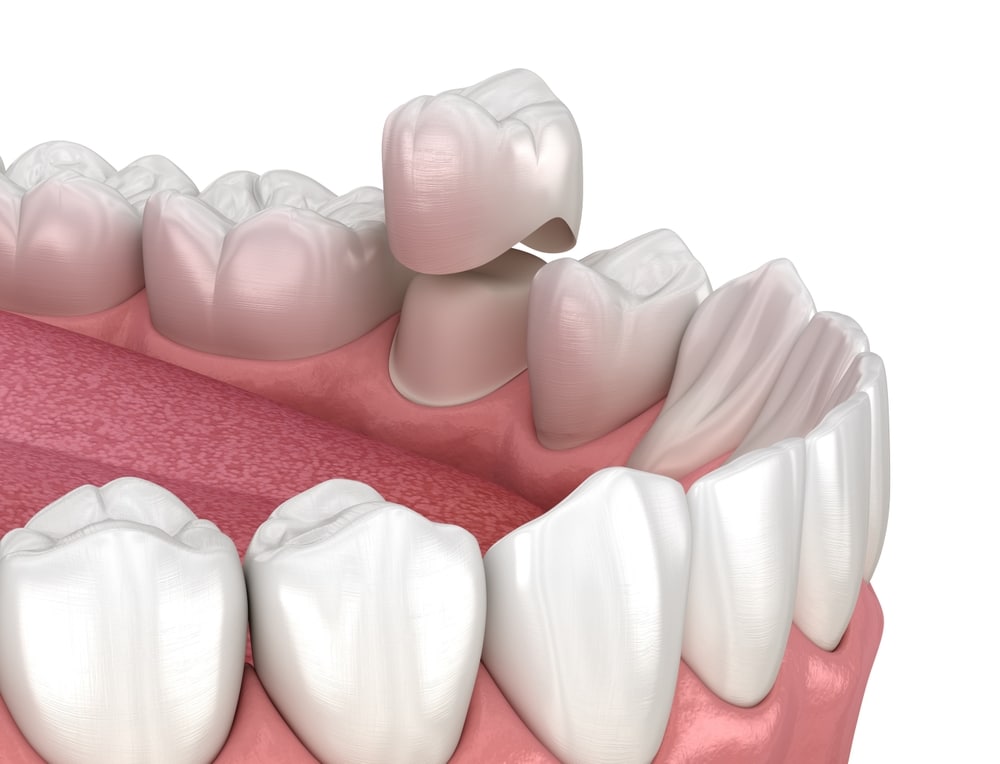dental crowns near me